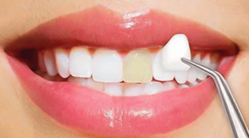 facettes dentaires contres indication dentiste lyon
