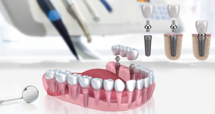 Le Dr Compagnone propose les implants dentaires Lyon