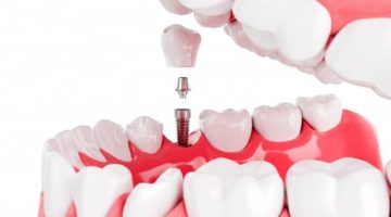 Le Dr Compagnone soins post opératoires implants dentaires Lyon