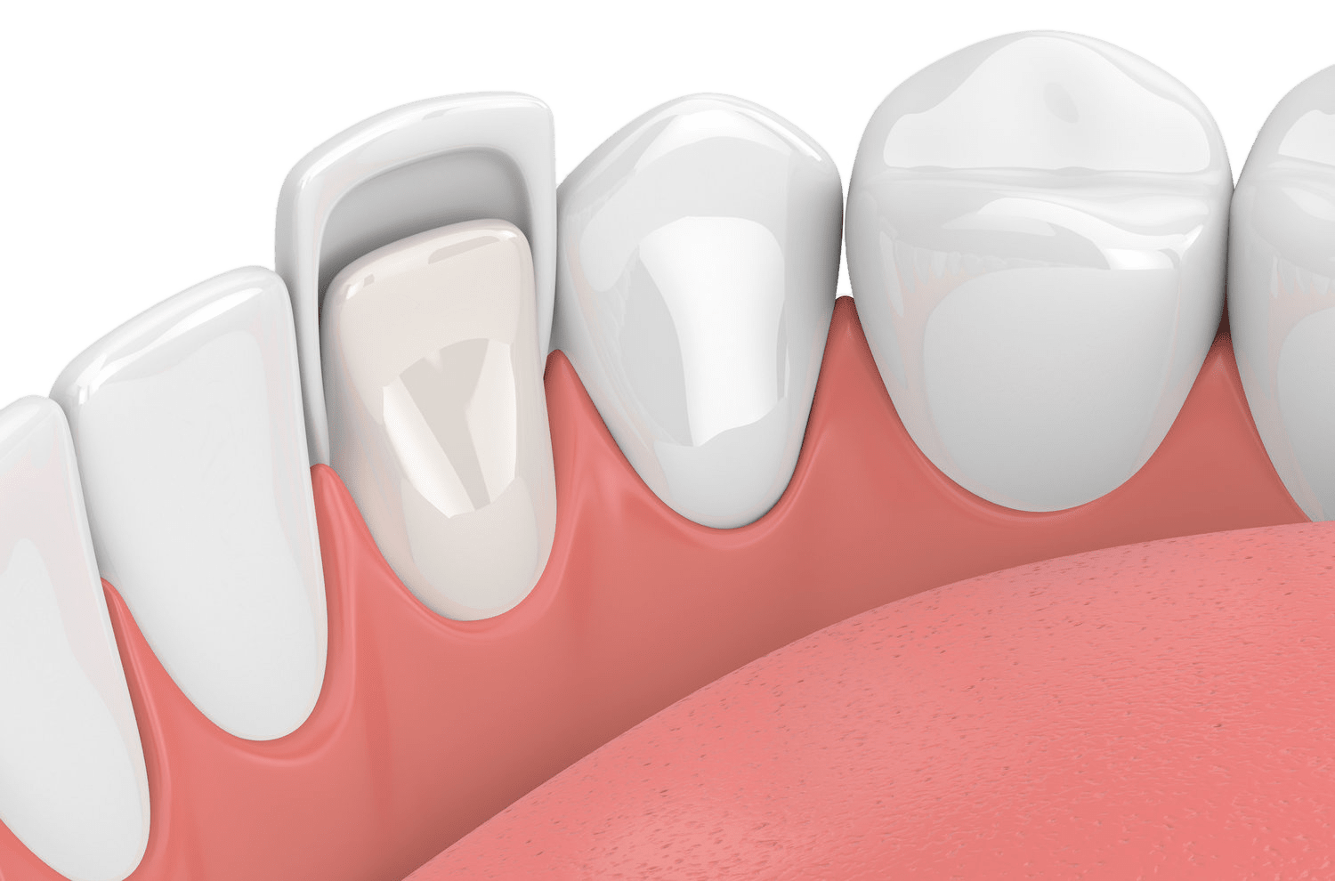 Le fonctionnement des facettes dentaires