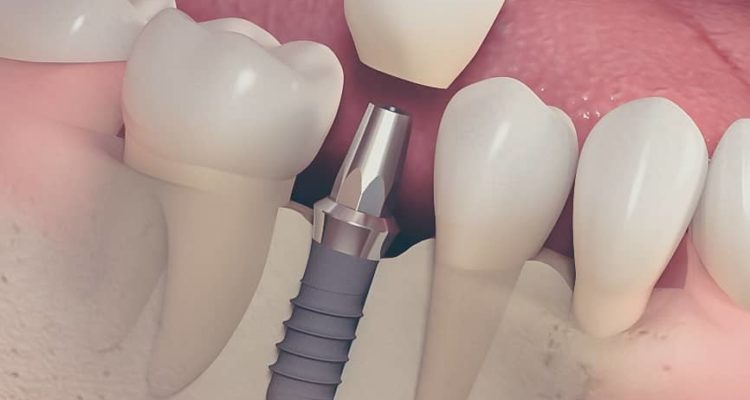 Pose implant dentaire chez votre dentiste Lyon