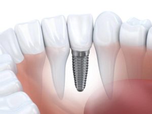 Implants dentaires dentiste Lyon
