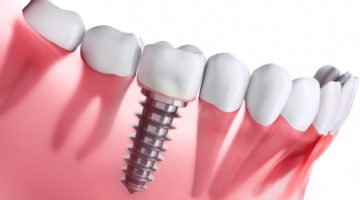 Votre dentiste à Lyon propose la pose d'implant dentaire