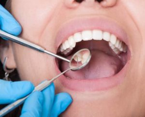 Soins dentaire détartrage dentiste à Lyon