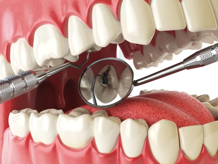 Traitement Des Caries Soins Dentaires à Lyon Dr Compagnone 